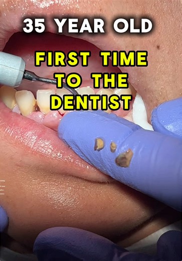 #drrosysmile #cheekydentist #tiktokdentist #rosydental #deepclean #deepcleaning #gumdisease #guminfection #orangecounty #santaana #bestdentist