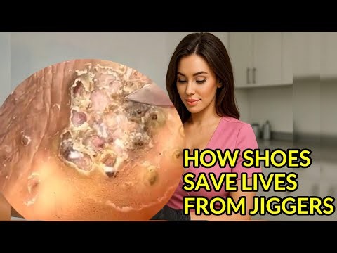 “Shoes Save Lives: Preventing Jiggers”