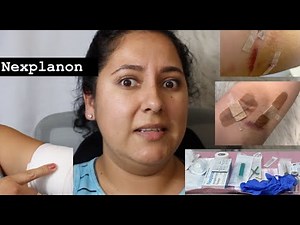 Nexplanon removal and insertion