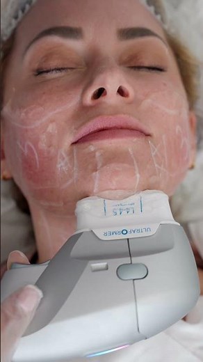 Revitalise Your Skin with HIFU Treatment at Este Medical | Watch the Process