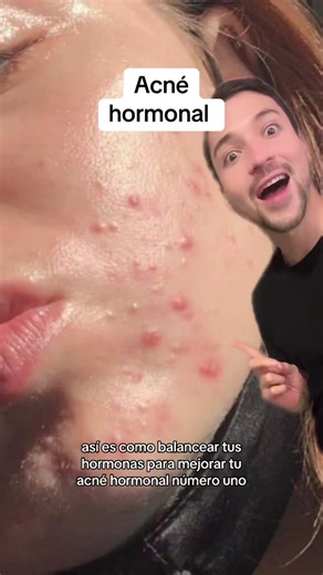 Tips para el acné hormonal #skincare #skincaretips #acne #acnetips #acnehormonal #testosterona #dht #sop #manchasdeacne #tedehierbabuena #repollo #silimarina #glutation #longervideos #greenscreen