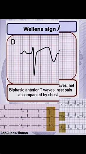✨🫀STEMI equivalents. #ecg #ekg #ecginterpretation #cardiology #MedicalEducation #hearthealth | Abdallah Othman
