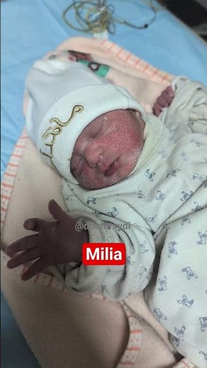Milia in Neonates #shorts #doctorxydi