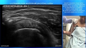 Biceps Tendon Tear with Loose Body vs Calcification within the Bicipital Groove, Supraspinatus Partial Articular-Sided Tear & Subscapular Tendinosis in a 65-Year-Old Female