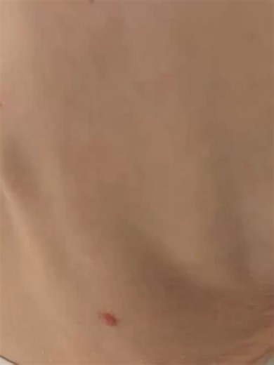 Understanding Hoover’s Sign in Clinical Practice