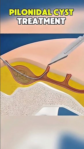 Pilonidal Cyst Treatment |3D ANIMATIONS| #pilonidalcyst #pilonidalsinus #pilonidaltreatment #fyp