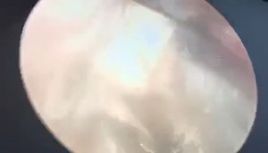 #Info_Santé : 📌 Chirurgie de L5S1 left disc herniation... UBE technique (unilateral biportal endoscopy). 📌 جراحة إنزلاق غضروفي بين الفقرتين L5S1 من الجهة اليسرى جراحة بالمنظار ، بطريقة UBE ☎️ 0561683708 ☎️ 0561683709 ☎️ 0561683710 #UBE unilateral biportal endoscopy #endospine #cliniqueeldjazair #dr_Kebi #Spine_endoscopy #Neurosurgery #neurochirurgie #IRM #Scanner #annaba | Clinique El Djazair Annaba