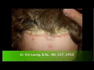 Dr Kin Leung Naturopathic Case Review Patient with Psoriasis Vulgaris plaque silver scales on scalp