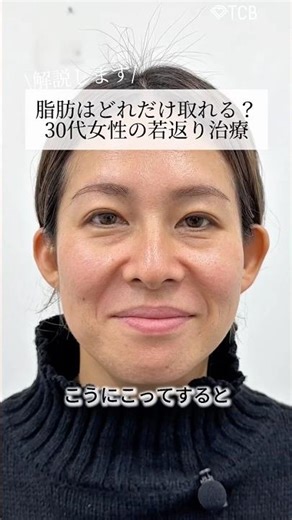 【クマ取り】脂肪はどれだけ取れる？30代女性の若返り治療#shorts