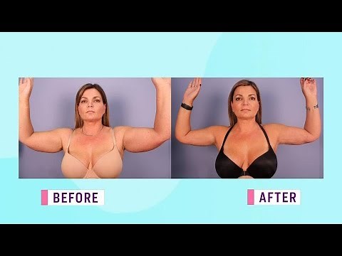 The new way to perform an arm lift surgery
