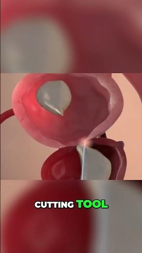 Doctor Explains Groundbreaking HoLEP Laser Prostate Procedure!