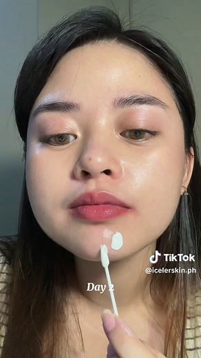 Effectively Remove Pimples with Icelerskin Acne Treatment Serum