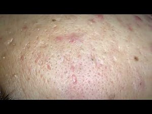 Extreme Acne & Blackhead Removal | Relaxing Spa Session