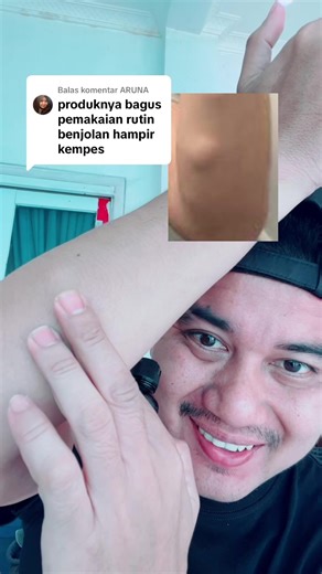 Solusi Ampuh untuk Benjolan dan Lipoma