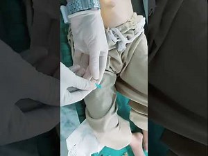 How to do Ascitic therapeutic tap | Ascites | Clinical skills | Department of medicine 🩸 💊