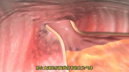 医学揭秘 胃酸返流 胃胀气是如何形成 看完你懂