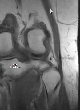 Lateral collateral ligament complex - normal anatomy
