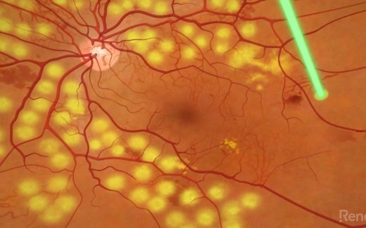 Diabetic Retinopathy Panretinal Photocoagulation - 糖尿病视网膜病变的全视网膜激光光凝治疗