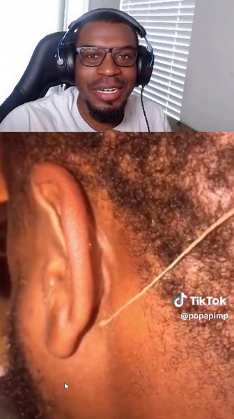 WATCH THIS HEAD PIMPLE POP! 😱😳 #pimple #cyst #pimples #pimplepop #reaction