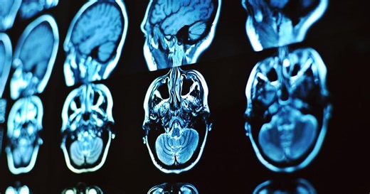Scientists think they’ve finally cracked the mystery of long COVID brain fog