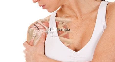 Lesión de hombro: Tendinitis del supraespinoso. ¿Qué es? Causas, ejercicios y tratamiento