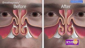 Improve your nasal breathing with help from Houston Advanced Nose and Sinus