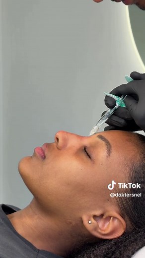 Balance without surgery✨ Nose fillers correct small bumps, lift the tip, or refine the profile all with natural looking results and minimal downtime. #nosecorrection #nosefiller #fillers #nonsurgicalnosejob #nonsurgicalrhinoplasty