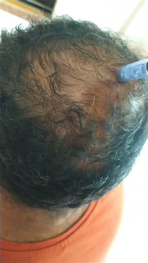 Dermapen To Hair Loss control Hair Regrowth Treatment
