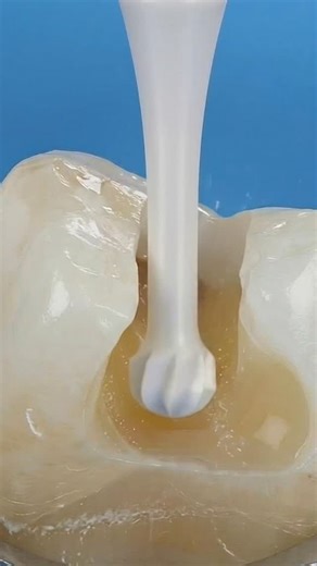 The Komet K1SM CeraBur ®️ gives you insane tactile feedback — you literally feel the exact moment you hit healthy dentin ✅ Credit @dr.fernandosoto @kometusa | Dental Art