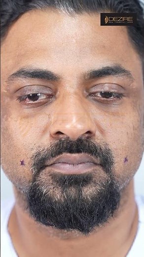 Dimple Creation Surgery