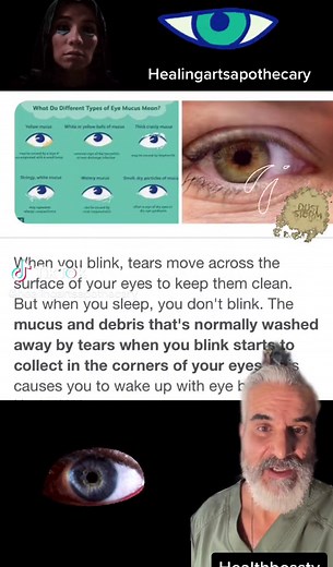 Understanding Eye Boogers: Causes, Prevention, and Removal Tips
