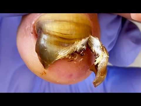 Repair Of Thick Tortoise Shell Like Nails【Dr. Liu's Pedicur】