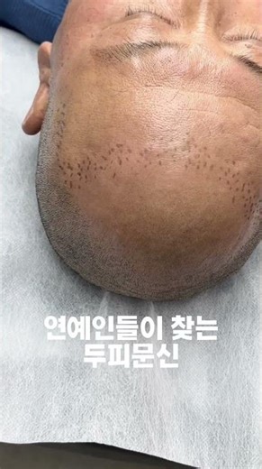 The epitome of shaved head tattoos #ScalpTattoo #SMP #CelebrityScalpTattoo #Celebrity #DBlack #DB...