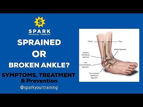 Sprained or Broken Ankle? Symptoms, Treatment, & Prevention