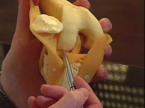 Dr. Lonner Explains Total vs. Partial Knee Replacement Surgery