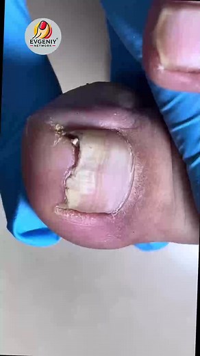 Natural Nail Solutions for Curved Nails That Prevent Future Issues #NailCareTips #CleanNailsDaily #SimpleNailCare #HealthyNails | Evgeniy