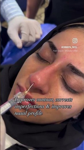 Before After Nose Filler for nose Reshaping | Liquid Rhinoplasty | Cosmetic clinic Thane