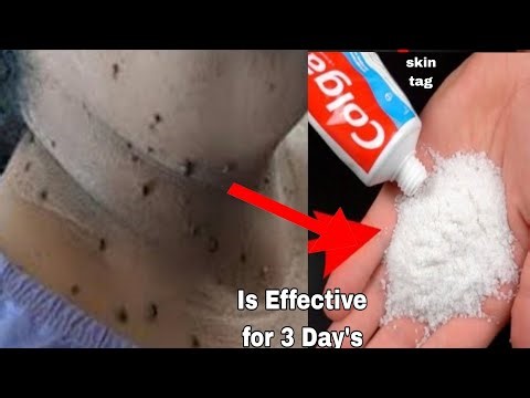 Remove skin tags naturally in 3 Day's how to remove skin tags challenge