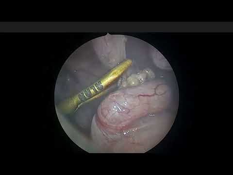 Lap appendectomy 4 yr boy. Spinal anesthesia is a game-changer minimizing risks compared to GA.