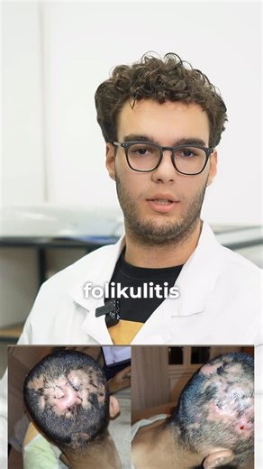 Folikulitis je upala folikula dlake, često uzrokovana bakterijama (najčešće Staphylococcus aureus), gljivicama ili iritacijom. Ovo stanje može izazvati crvenilo, svrab, bol i pojavu gnojnih bubuljica ili čvorića na koži. Uzroci folikulitisa: 1. Bakterijska infekcija (najčešće stafilokok). 2. Iritacija kože od trenja (npr. uska odeća) ili brijanja. 3. Zapušeni folikuli dlake usled ulja, znoja ili proizvoda za kožu. 4. Gljivične infekcije (npr. Malassezia). 5. Vruća voda ili nečiste kade (npr. fol
