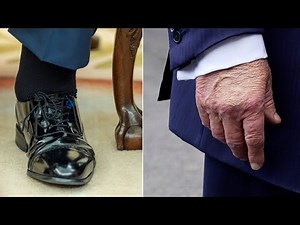 Trump diagnosed with vein condition tied to swelling in legs