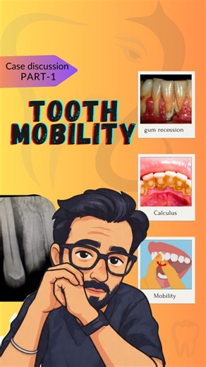 Dr Mayank Mathur | Dentist | Ekdantay Dental Clinic | Jaipur on Instagram: "90% people notice tooth mobility… but 0% take it seriously.” Don’t be that 0%. Learn how to save your teeth 👇 CASE DISCUSSION – PART 1 | TOOTH MOBILITY 🦷 This patient had severe calculus deposits, gum recession, and advanced bone loss leading to Grade-III mobility. Clinical evaluation + X-ray confirmed that the tooth could not be saved — extraction was the safest decision. But here’s the important part: T