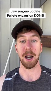 Jaw surgery update! The expander is finally OUT of my mouth and I have finally healed from surgery one, palate expansion. I’ve also got nice teeth for the first time in my life! Surgery two coming up hopefully in june, maxilomandibular advancement surgery or MMA.Next step: design my new face.Currently, sleep apnea symptoms are worse but that is to be expected at this point in the journey. Halfway done now. #jawsurgery #jawsurgeryrecovery #mmasurgery #osa #sleepapnea #срар #palateexpander #braces