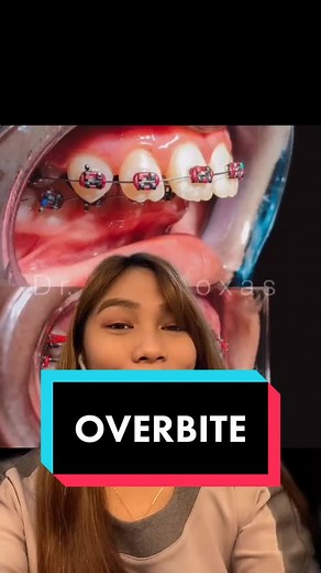 Understanding Overbite: How to Fix Overbite Teeth