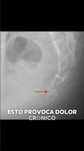 Subluxación del Coxis: Dolor Crónico al Sentarse después de un Golpe