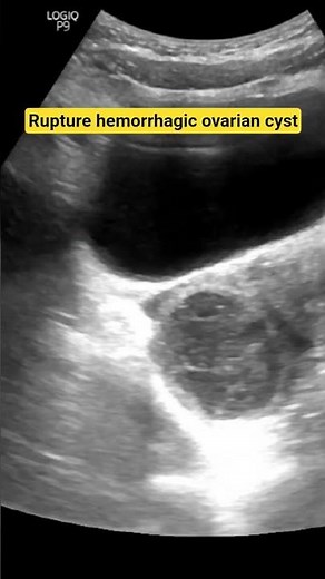 Rupture Hemorrhagic Ovarian Cyst. #medicaleducation #ultrasound