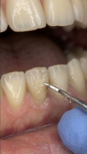 Rebuilding a Broken Tooth 🦷 Composite Restoration Step-by-Step | #satisfying #brokentooth #short