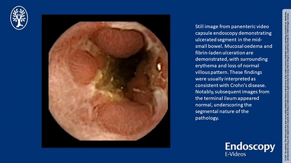 An unforgettable diagnostic journey: multimodal evaluation of jejunal diverticulitis mimicking Crohn’s disease