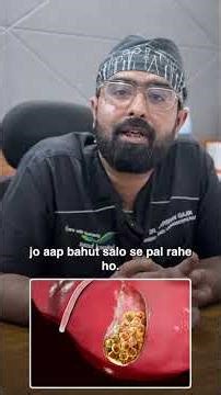 Can Gallstones Cause Cancer? The Hidden Risk of Long-Standing Gallbladder Stones