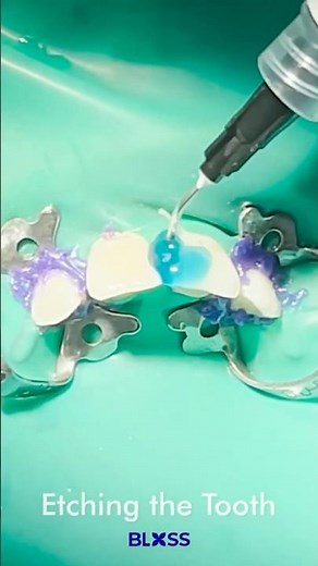 Blue Gel Stage: Etching the Tooth 🦷✨
